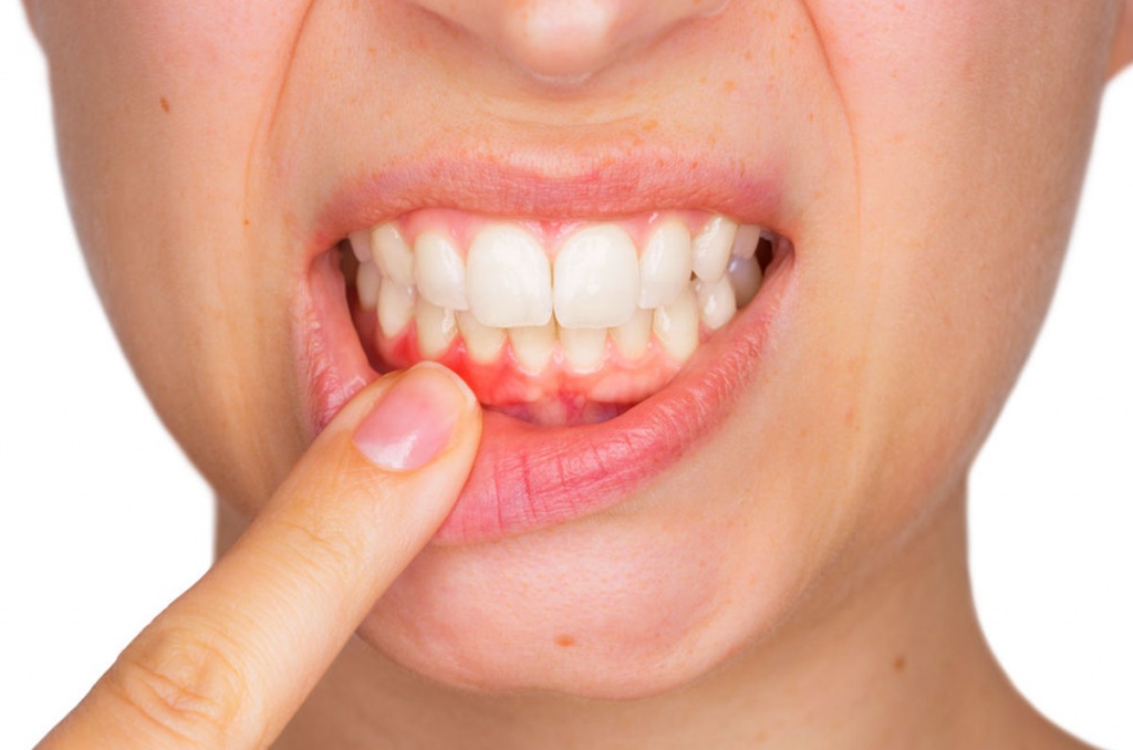 Чем опасно воспаление десен - Методы лечения воспаления десен зубов