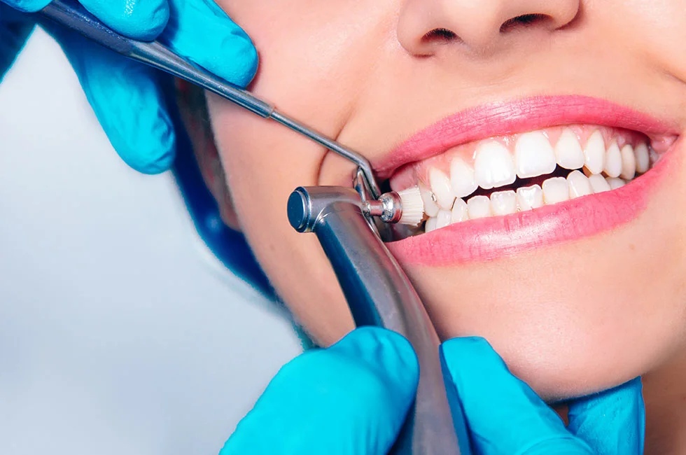 Удаление зубного камня - Профессиональная чистка