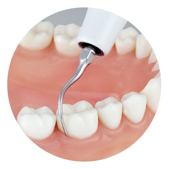 Методы удаления зубного камня