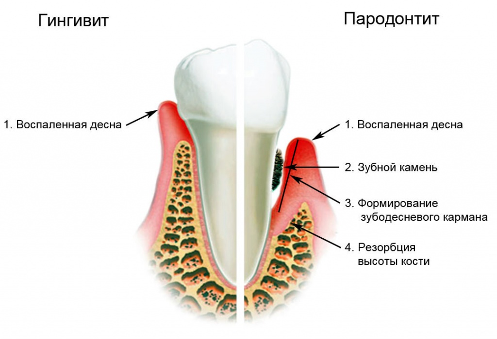 Лечение воспаления десен зубов - Лечение пародонтита