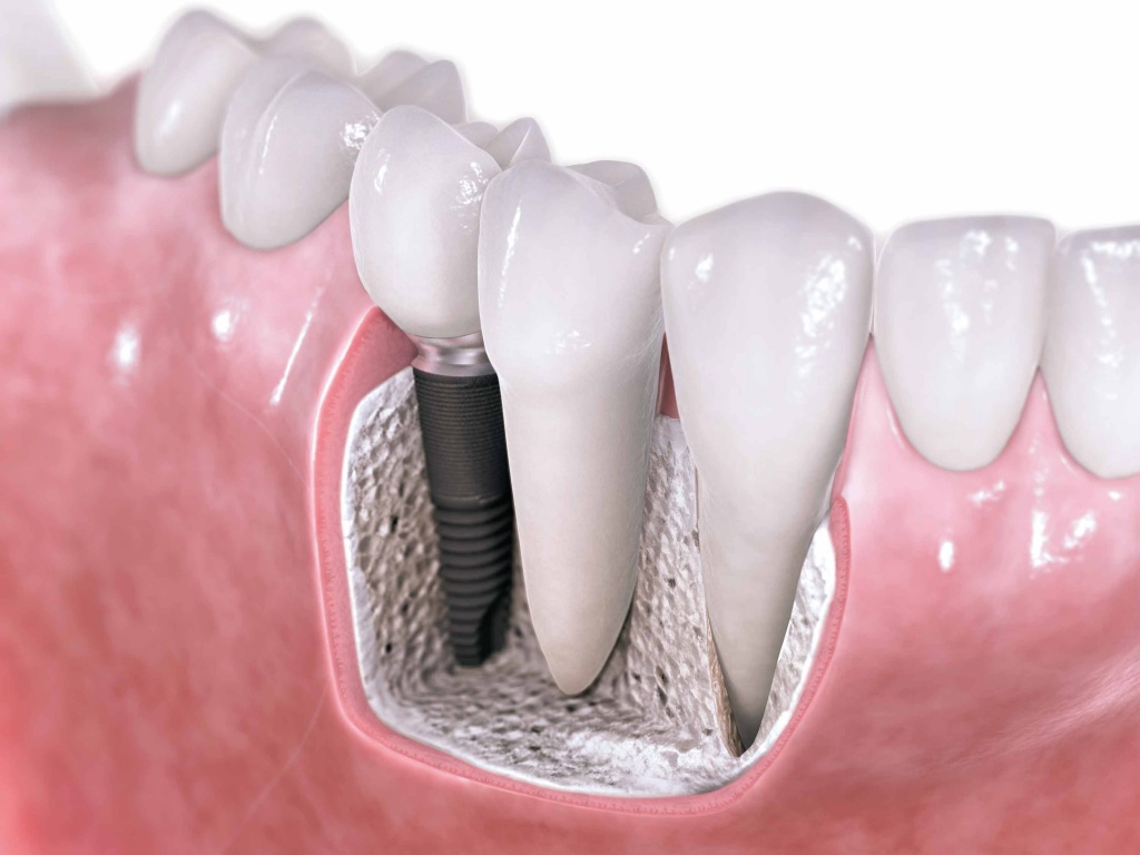 Гигиена полости рта после имплантации зубов